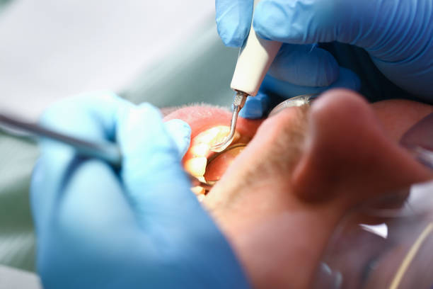 Best Emergency Wisdom Teeth Removal in Rancho Cordova, CA